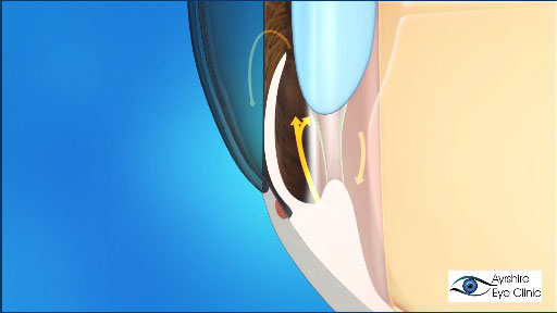 angle closure glaucoma
